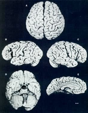 20. Yüzyılın Bilimadamı Einstein'in Beyni 240 Parçaya Bölünerek İncelendi